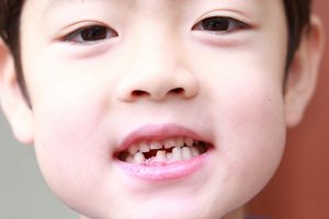 子どもの歯並びは遺伝?